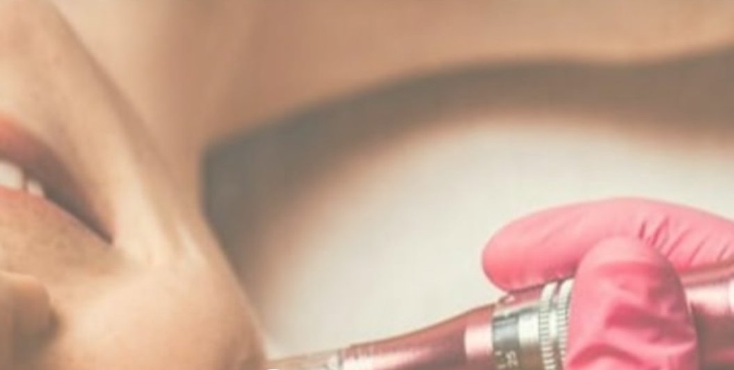 Sesión de microneedling con Dermapen sobre la mejilla
